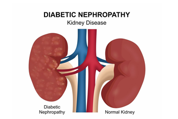 Diabetic Nephropathy Management